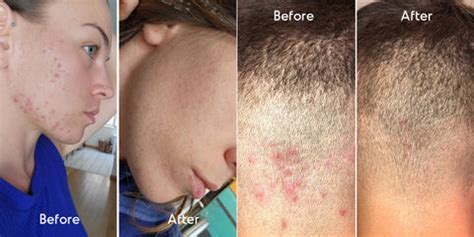 Fungal Acne Before and After – Almond Clear