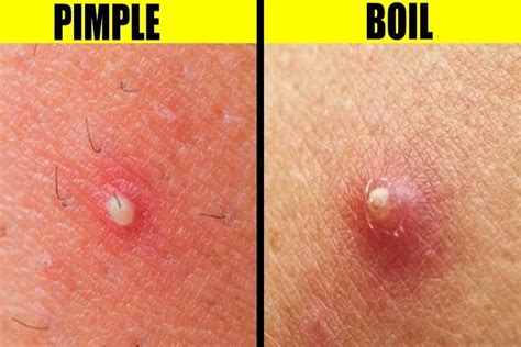 Boil Vs Cyst - The True Differences Between The Two