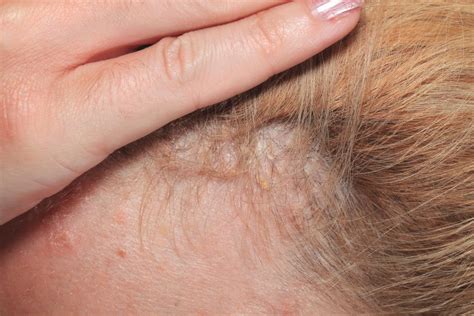 Scalp psoriasis: Symptoms, causes, and treatment