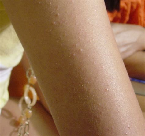 Keratosis Pilaris (K.P.) is a skin condition effecting roughly half of the population and ...