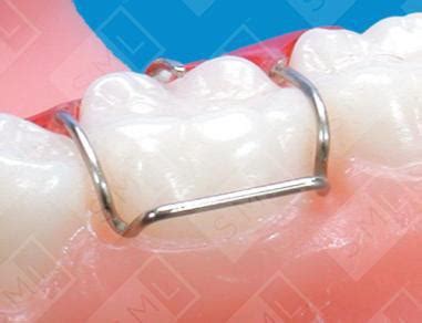 Adam's Dental Clasps, Dental Appliance Clasps | SML | Southwest