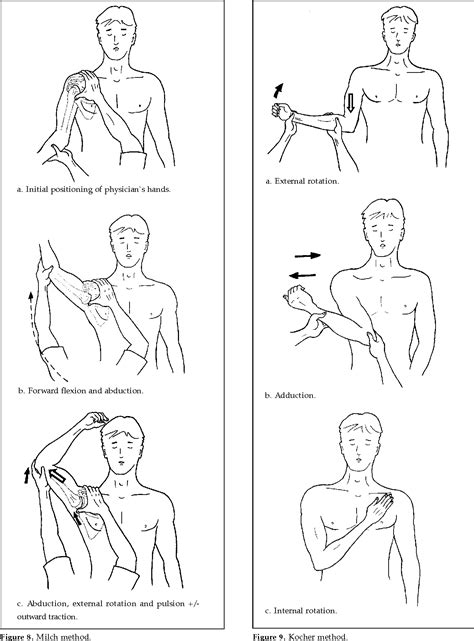 [PDF] Closed Reduction Techniques for Acute Anterior Shoulder Dislocation: from Egyptians to ...