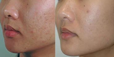 Laser Scar Removal Cost - Is it worth the price? Nexus Clinic Kuala Lumpur