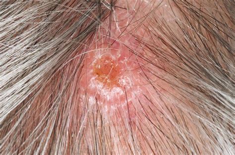 Early Squamous Cell Skin Cancer Signs