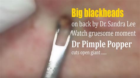 Big blackheads on back by Dr. Sandra Lee - YouTube