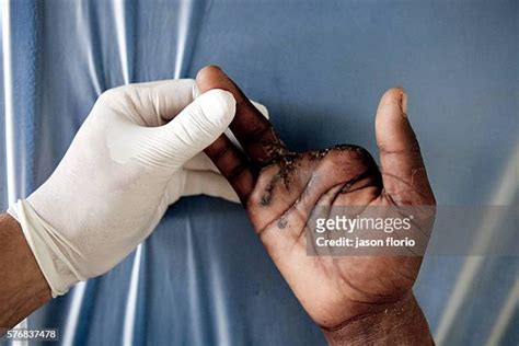 Amputated Finger Photos and Premium High Res Pictures - Getty Images