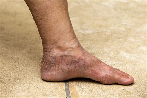 Understanding Varicose Veins in the Feet | Vein Institute Of Pinellas