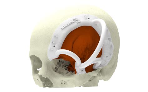 Meningioma resection + reconstruction | Xilloc