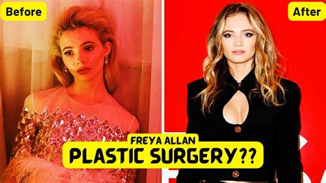 Has Freya Allan had plastic surgery? Botox and nose job rumors