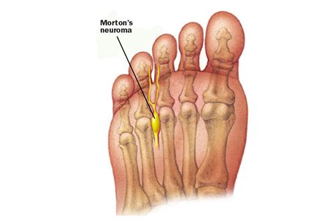 Morton’s Neuroma London UK - Foot Surgery London