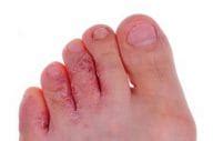 Foot Cellulitis - Things You Should Know | Ecellulitis Healthy Living