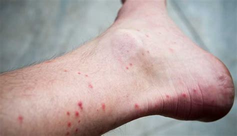 Flea Bites: What They Look Like, Symptoms & Treatment