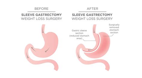 What is a Sleeve Gastrectomy? - Winnett Specialist Group