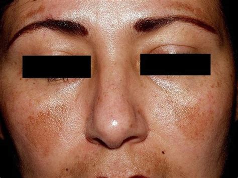 Melasma causes, symptoms, diagnosis & best treatment for melasma on face