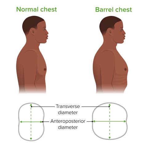 Enfermedad Pulmonar Obstructiva Crónica (EPOC) | Concise Medical Knowledge