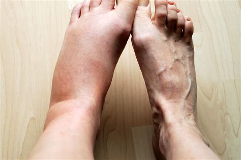 Diabetes Symptoms Feet Swelling