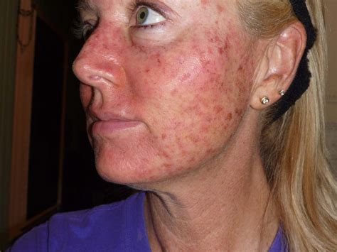 Actinic Keratosis: Woman Shows Treatment With Painful Photos | atelier ...