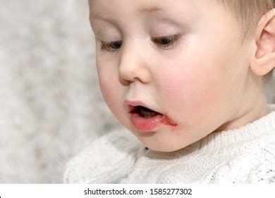 Acute Herpetic Stomatitis Children Infectious Viral Stock Photo 1585277302 | Shutterstock