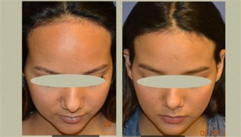 Lower Your Hairline With a Surgical Procedure | Forehead reduction ...