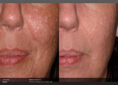 Laser Scar Reduction Eugene OR | Scar Removal | Cascade Dermatology and Aesthetics