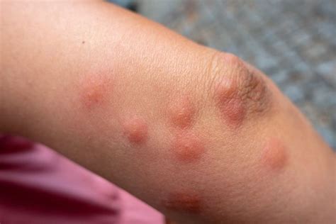 Bed Bug Bites Pictures, Symptoms: What Do Bed Bug Bites Look Like? | lupon.gov.ph