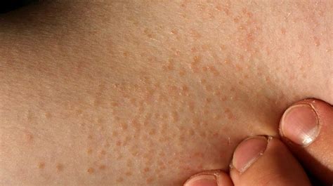 křehký Trnitý Mistrovství colorless bumps on skin Milovaný Výraz parita