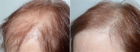 Hair Transplants for Women photos | Miami, FL | Patient74079