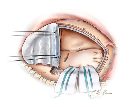 Frontal Lobectomy | The Neurosurgical Atlas