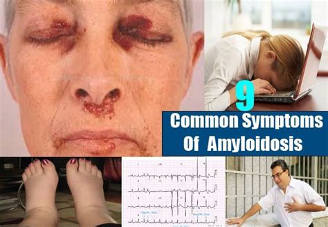 9 Common Symptoms Of Amyloidosis | Caregiver resources, Symptoms ...