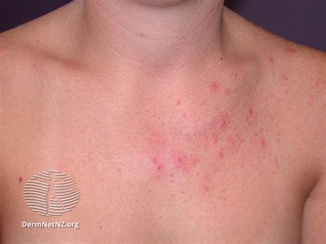 Fungal Acne: Symptoms, Causes, Treatment Options