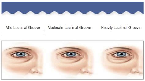 Body Contouring / Lipofilling / Autologous Fat Lacrimal Groove_Plastic Surgery,Cosmetic Surgery ...