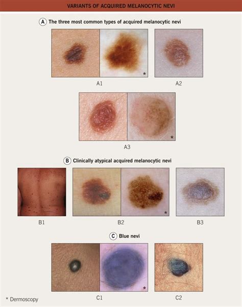 Acquired Melanocytic Nevus