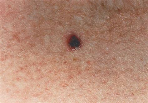 What Is Stage 4 Melanoma Skin Cancer Cancerwalls - vrogue.co