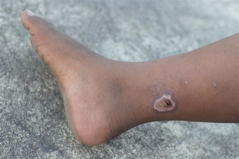 Infected Venous Ulcers Icd 10 at Rose Jackson blog