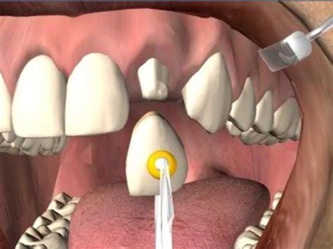 How Long do Dental Crowns Last on Front Teeth? - 911 WeKnow