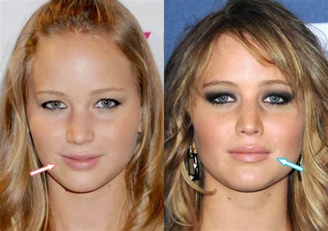 Has Jennifer Lawrence Had Plastic Surgery? (Before & After 2022)