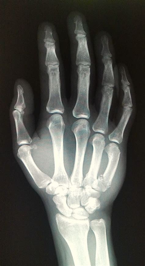 hand x-ray | Xray art, Anatomy, Hand reference