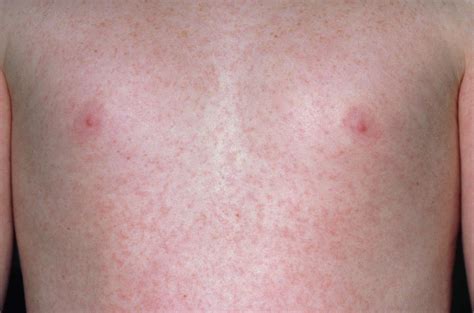 Rubella: Symptoms, Treatment, Complications