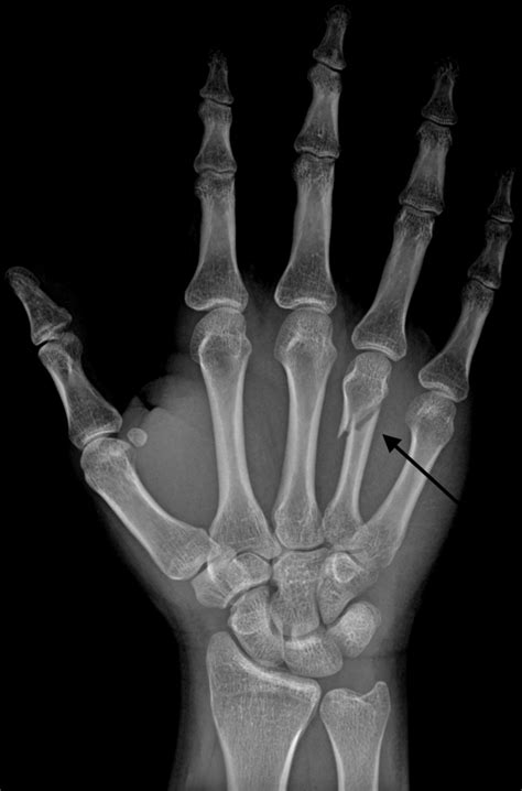 Metacarpal Fracture Treatment - Manchester Hand & Wrist Surgery