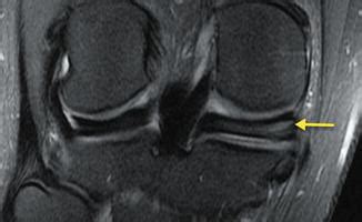 Imaging of Meniscus Pathology | Musculoskeletal Key