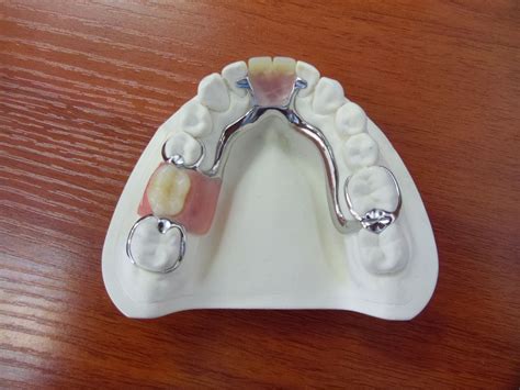 Maxillary Partial Denture Cast Metal