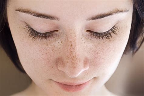 10 of the Best Methods for Freckles Treatment - Healthwire