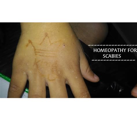 TOP 4 HOMEOPATHIC REMEDY FOR SCABIES - ALL ABOUT SCABIES