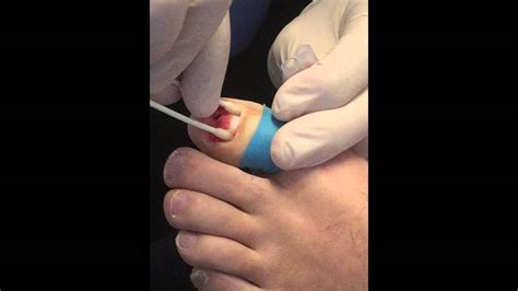 Phenol Matrixectomy - Permanent Nail Removal - YouTube