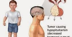 Medical Treatment Pictures-for Better Understanding: Growth Hormone Deficiency-Hypopituitary ...