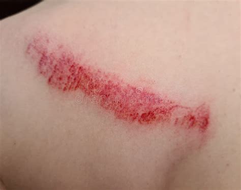 Severe Wound on Back Scratch Closeup. Child Injury Stock Image - Image of human, abrasion: 246880011