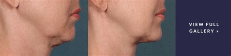 Kybella (Double Chin Reduction) Seattle, WA | Seattle Face & Skin