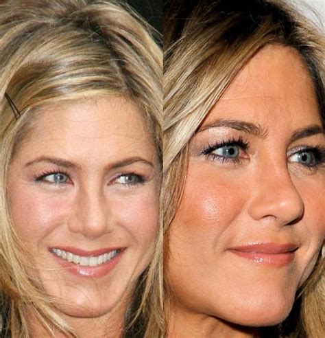 Jennifer Aniston Surgery Before After