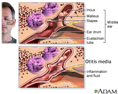 HIE Multimedia - Ear infection - chronic