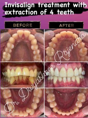 Before and After| Invisalign| Protruded, crowded teeth correction with ...